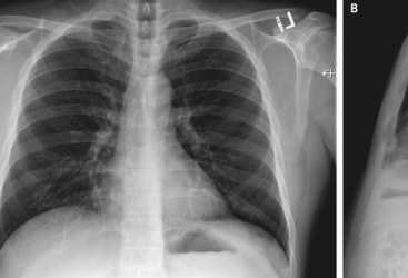 Ermənistanda koronavirusa yoluxanların sayı 50 minə yaxınlaşır