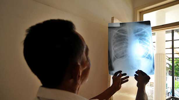 COVID-19 gizli vərəmi aşkara çıxara bilər