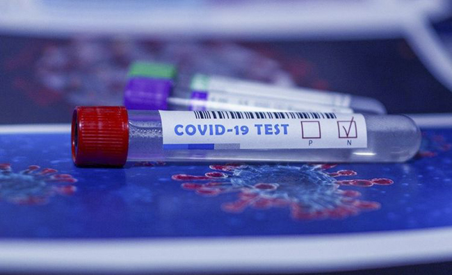 Azərbaycanda indiyədək 1126538 koronavirus testi aparılıb