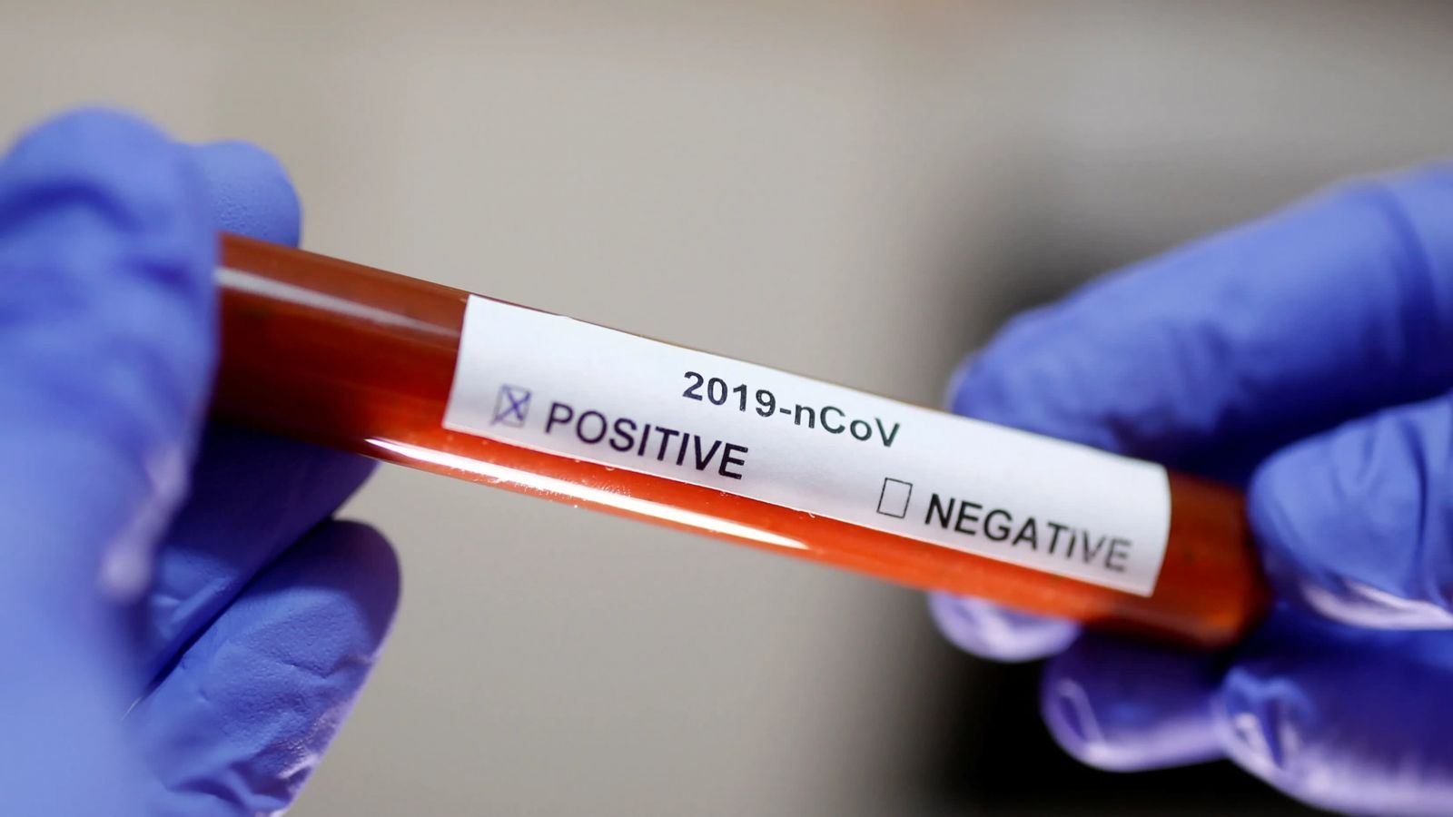 Britaniyada 16 min qeydə alınmayan koronavirusa yoluxma halı aşkarlandı