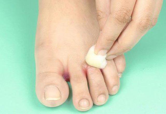 Bu iki sadə komponentin qarışığı ayaq dırnaqlarındakı göbələk xəstəliklərini sağaldır