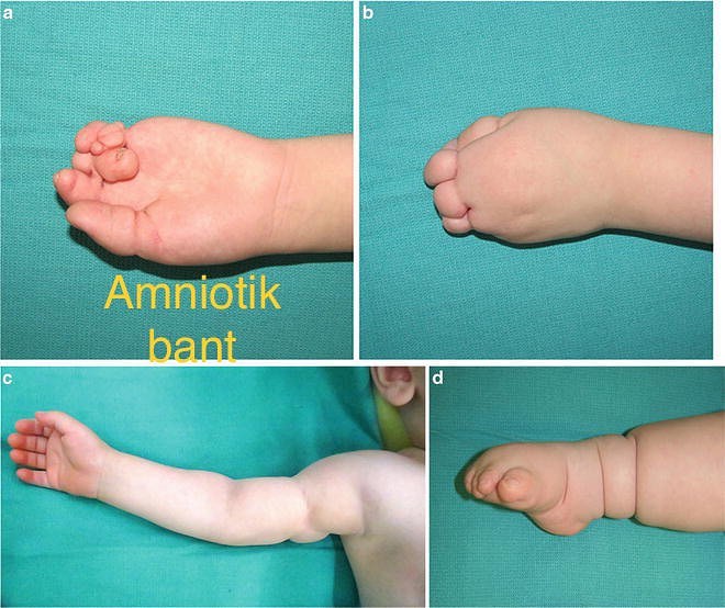 Amniotik bant sindromu necə yaranır? - Səbəbləri/Müalicəsi