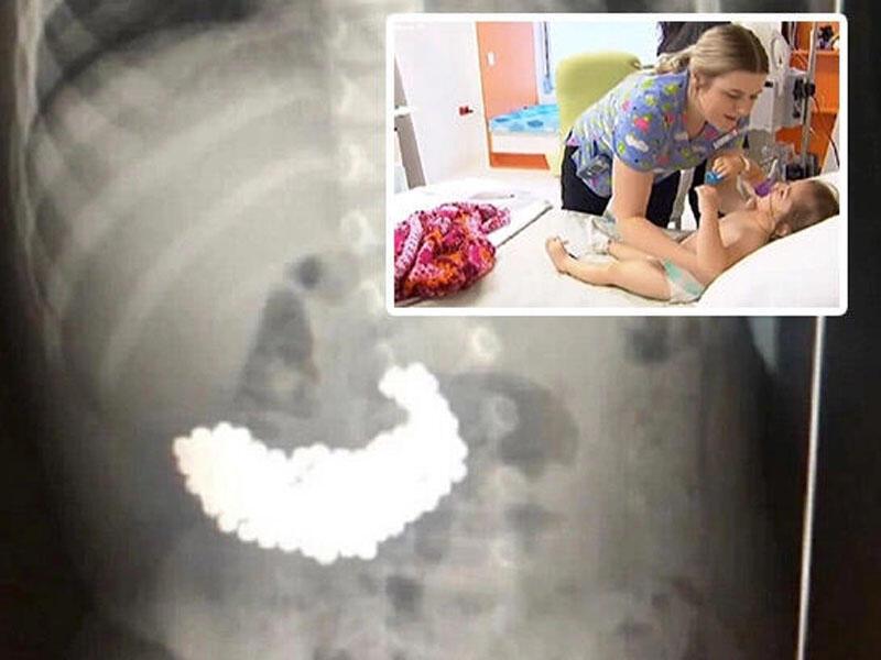 İki yaşlı uşağın mədəsindən 209 maqnit topu çıxdı