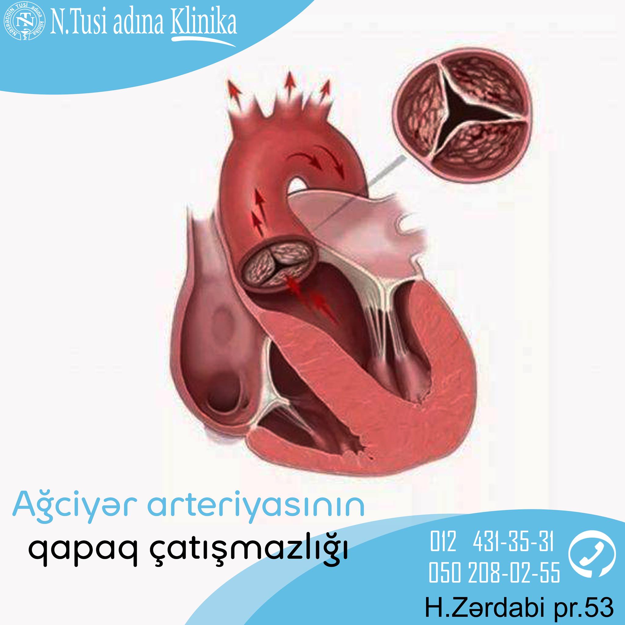 Ağciyər arteriyasının qapaq çatışmazlığı: diaqnostikası və müalicəsi