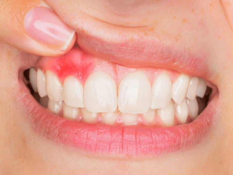 Bu vitamin diş əti sağlamlığına müsbət təsir edir