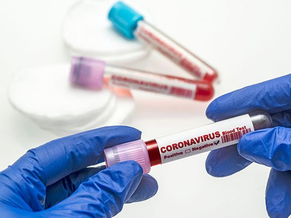 Daha 722 nəfərdə koronavirus aşkarlandı, 15 nəfər vəfat etdi