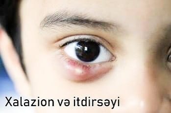 Xalazion xəstəliyini itdirsəyindən fərqləndirən ƏLAMƏTLƏR