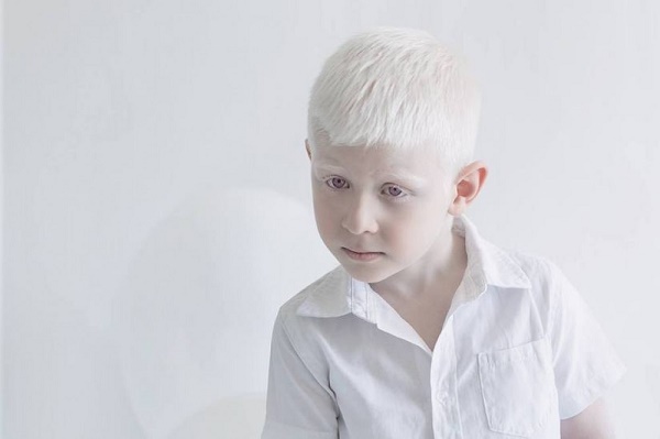  13 iyun - Beynəlxalq Albinizm haqqında Maarifləndirmə Günüdür   
