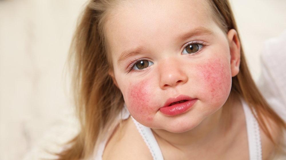 Baş pediatr: Uşaqlarda yay aylarında qidalanma problemləri və allergik xəstəliklərə daha çox rast gəlinir