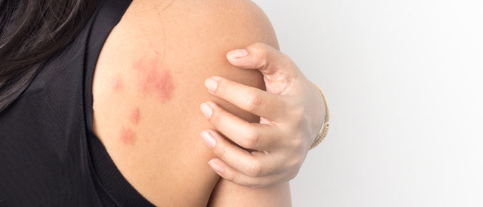 Günəş allergiyası nədir? - Əsas simptomları və müalicəsi