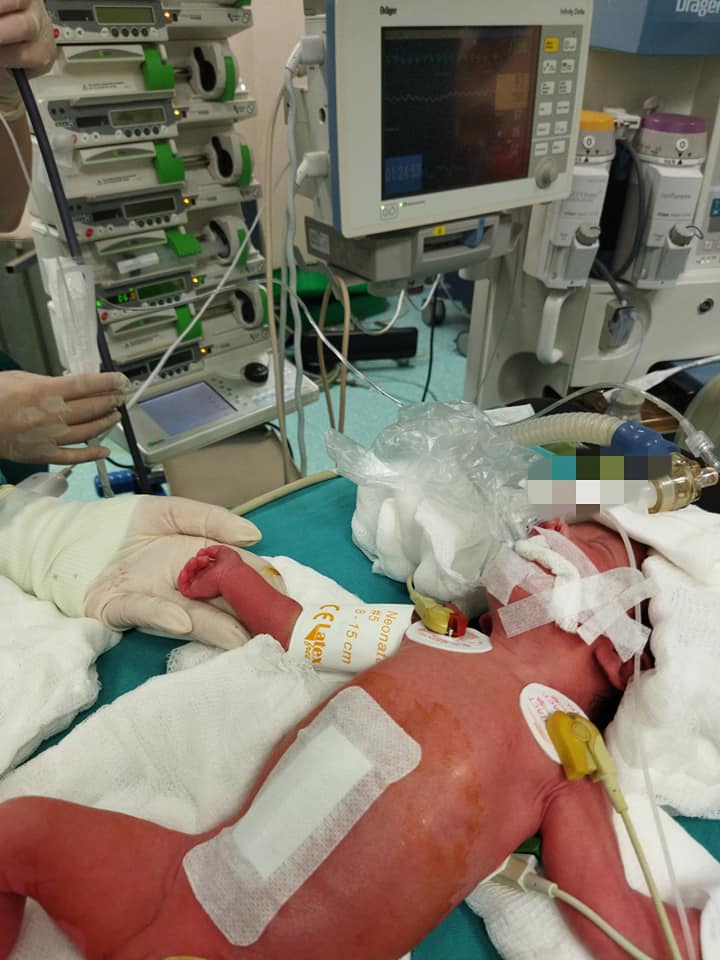 Mərkəzi Klinikada qaraciyəri və bağırsaqları çöldə doğulmuş körpə uğurla əməliyyat olunub (FOTO)