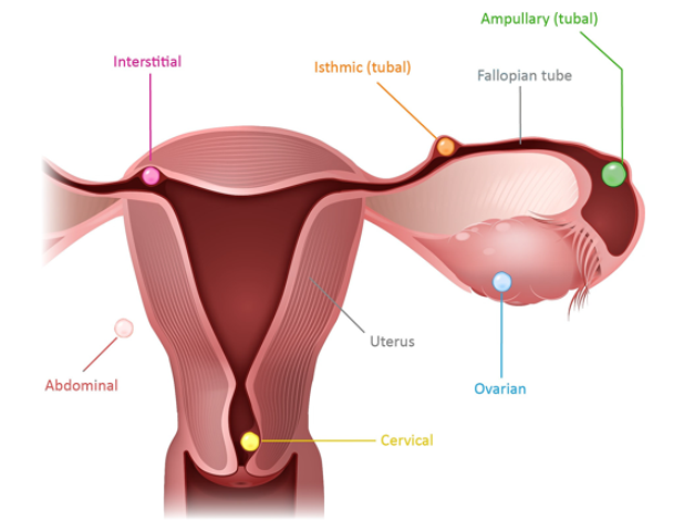 Həkim reportajı: İntrastisial hamiləlik və səbəbləri