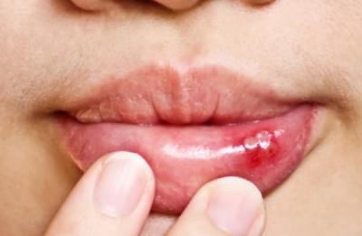 Herpes viruslarından qurtulmaq mümkündürmü?