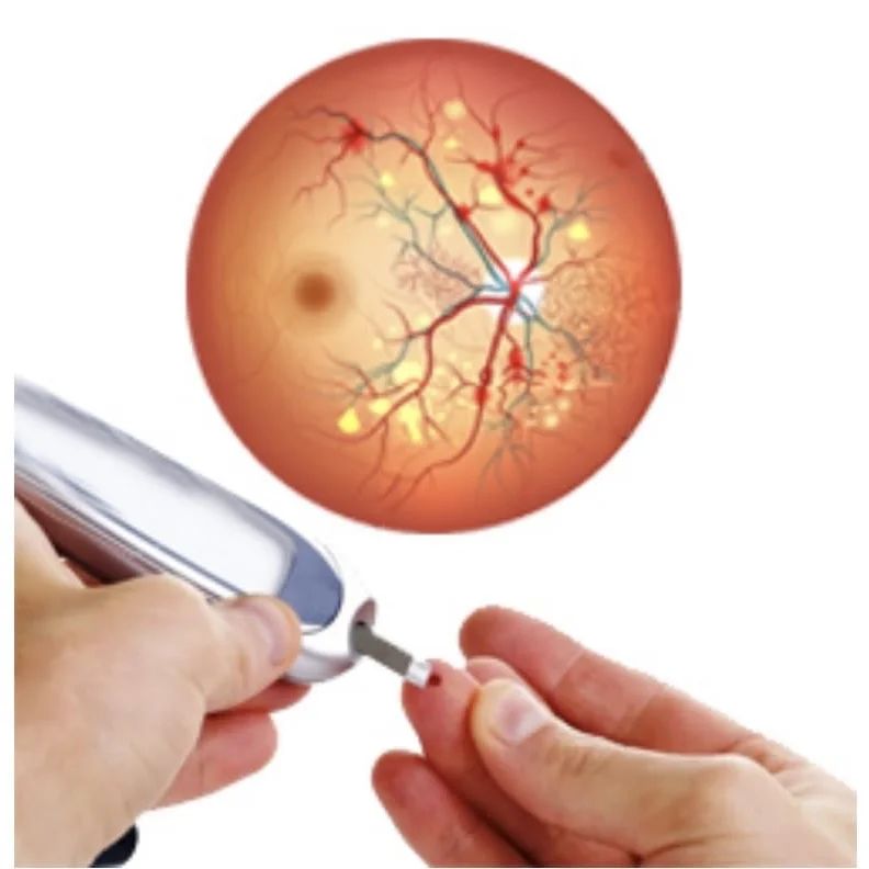  Şəkərli diabetin gözün tor qişasının damarlarını zədələməsi  ilə yaranan - Diabetik retinopatiya