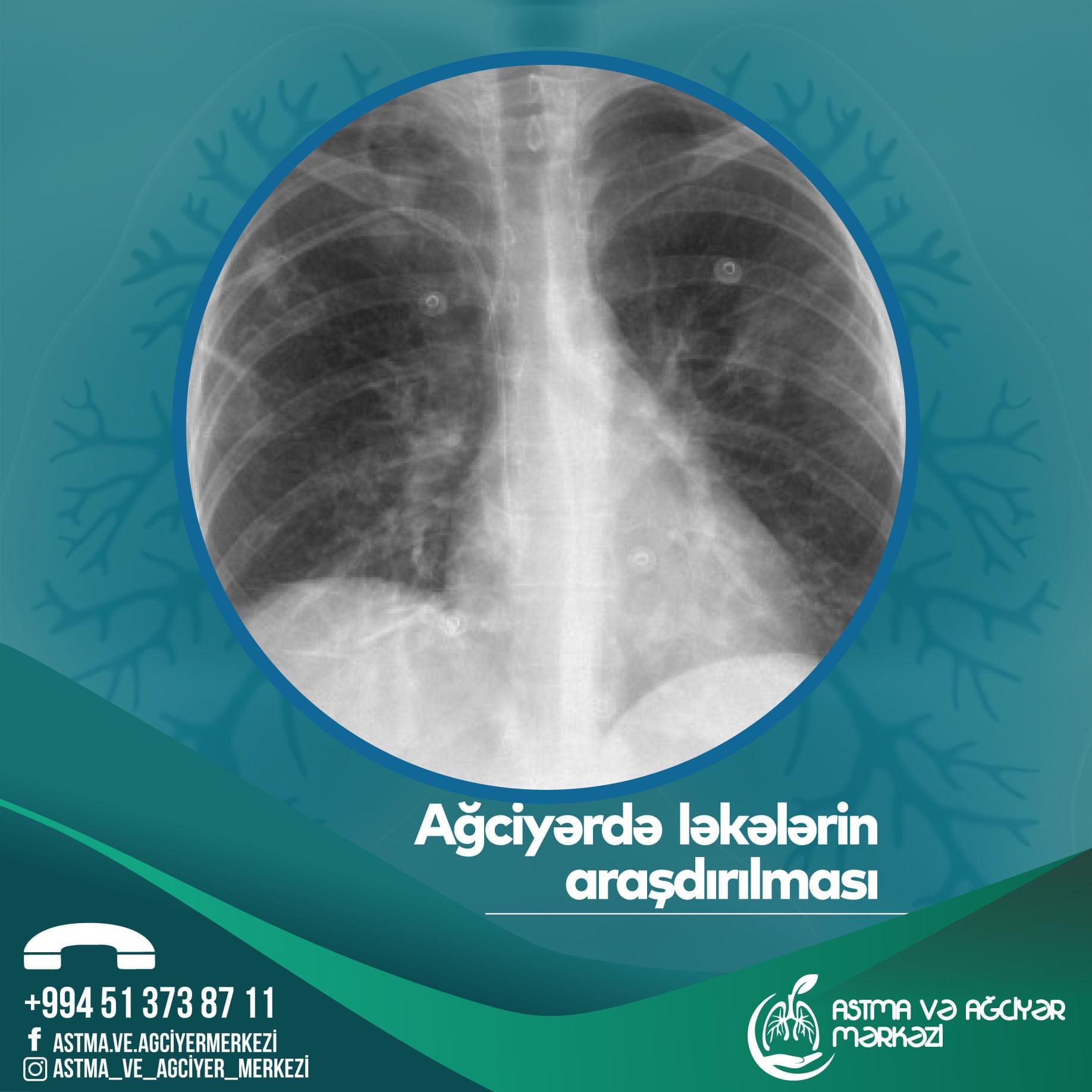 Ağciyərdəki ləkələrin araşdırılması - 