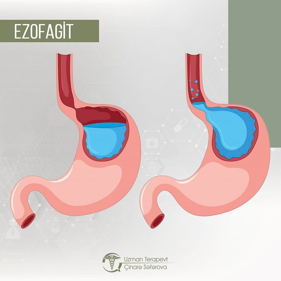 Həzm traktının geniş yayılmış xəstəliklərindən biri - Ezofagit