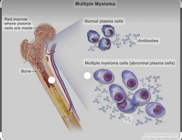 Səbəbsiz anemiya aşkarlanarsa çoxsaylı Mieloma xəstəliyinin olması inkar edilməlidir - Hematoloq 