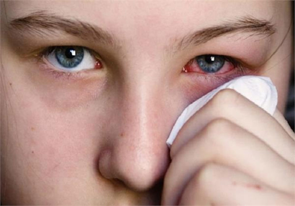 Gözdə qəflətən başlayan qaşıntı, yanma, qızartı və sulanma ilə müşahidə olunan - Allergik konyunktivitin yaranma SƏBƏBLƏRİ nədir?