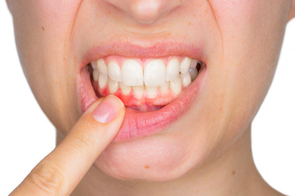 Karbohidratlı qidalar diş əti xəstəliklərinin yaranmasına səbəb olan bakteriyalar yaradır