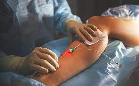 Endovenoz lazer ablasiya metodunun ÜSTÜNLÜKLƏRİ  