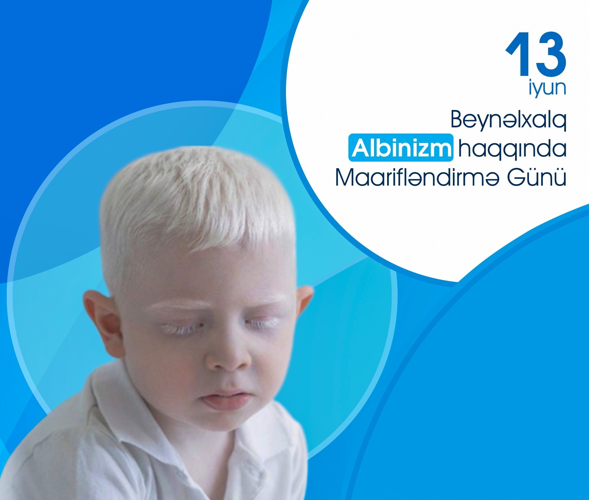 13 iyun - Beynəlxalq Albinizm haqqında Maarifləndirmə Günüdür