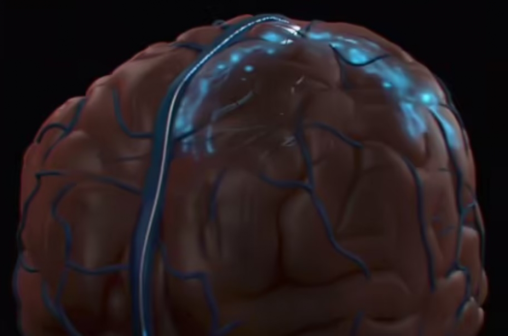 ABŞ-da ilk dəfə olaraq insan beyninə daimi implant yeridilib