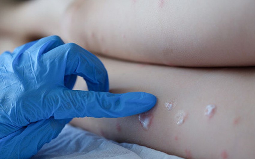 Meymunçiçəyinin müalicəsində istifadə olunan dərmanlar açıqlanıb