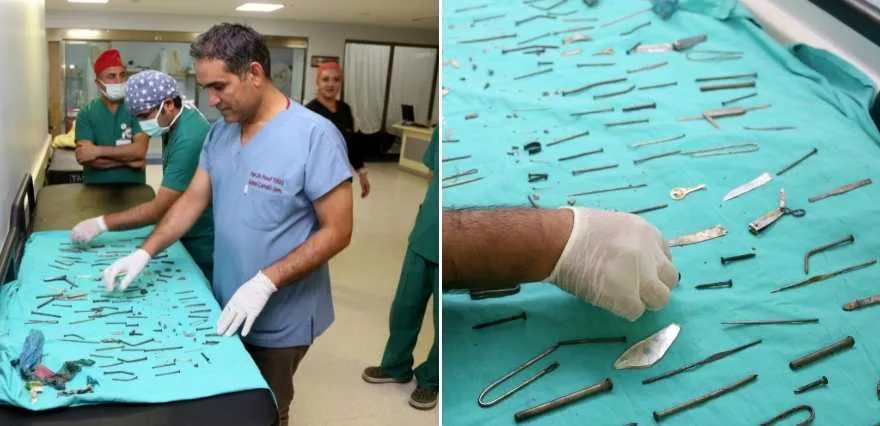 Türkiyədə həkimlər 25 yaşlı qızın mədəsindən bir ovuc mismar çıxarıblar