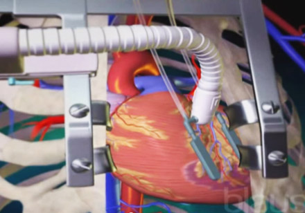 Aorta koronar şuntlama əməliyyatı icbari tibbi sığorta ilə təmin olunurmu?
