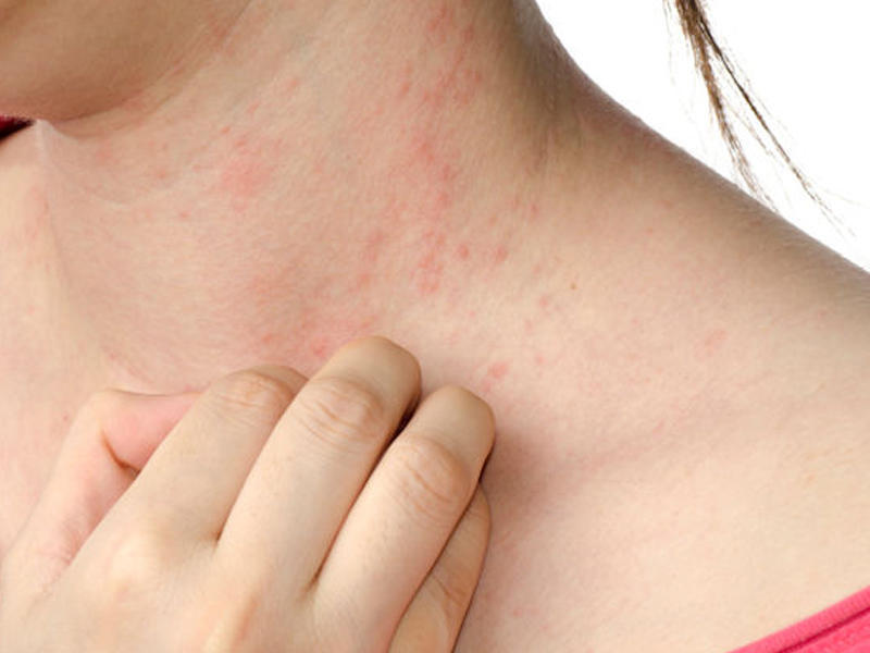 Qida allergiyasının simptomları - Uzman həkim açıqladı