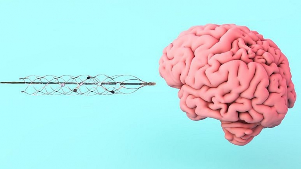 Rəqəmsal cihazları idarə etmək üçün beyin implantı yaradılıb