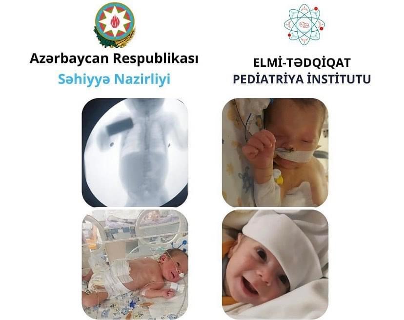 VACTERL sindromu ilə doğulan körpə sağlamlığına qovuşub 