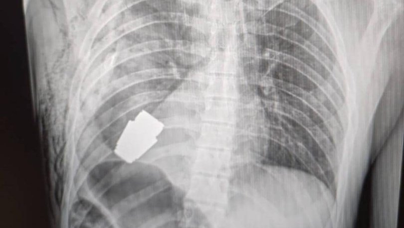 Cərrahlar Ukrayna əsgərinin sinəsindən partlamamış qumbara çıxarıblar