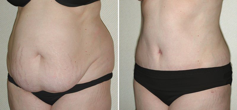 Abdominoplastika (qarın gərmə) əməliyyatına böyük ENDİRİM - cəmi 1600 AZN!