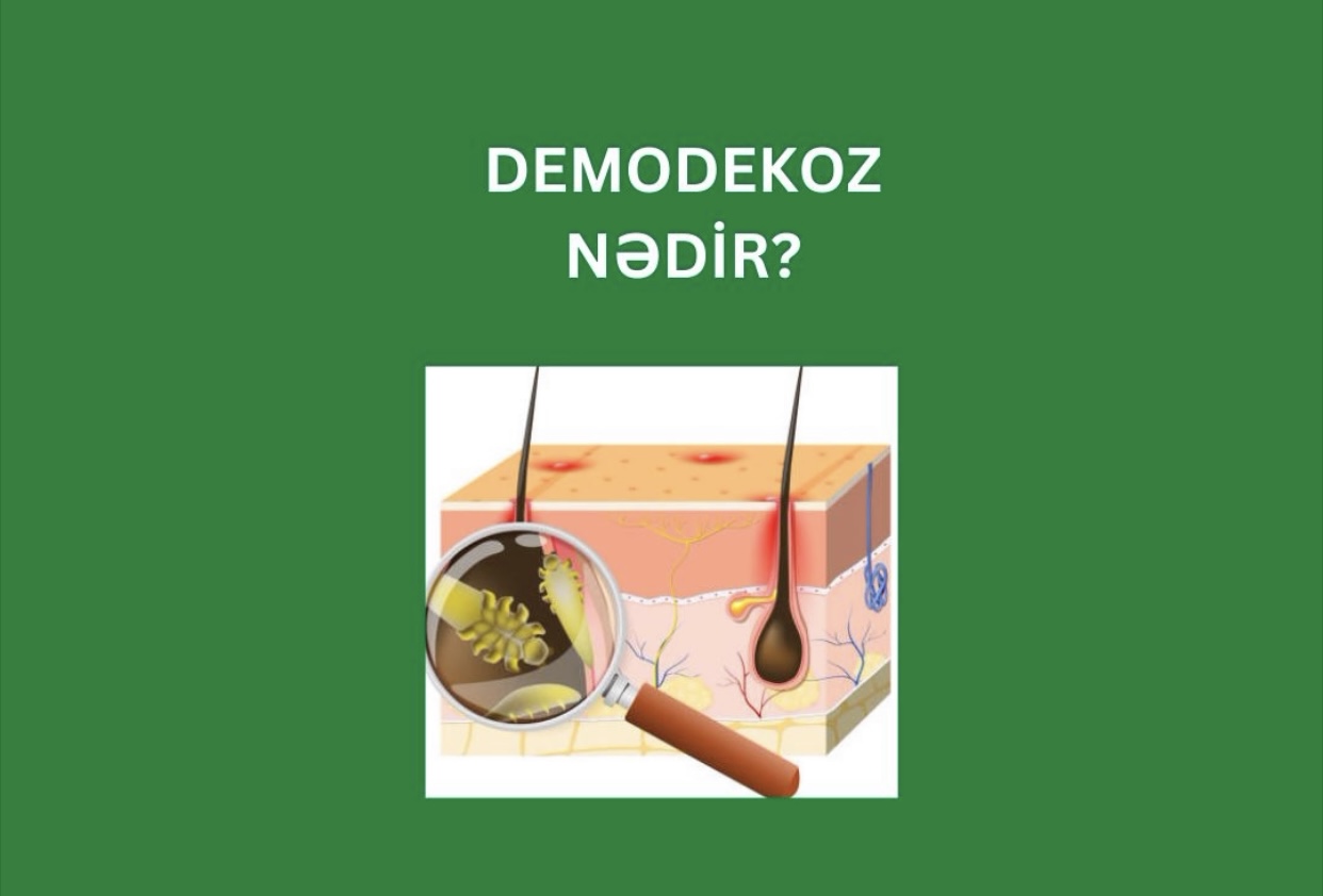 Demodekoz nədir?