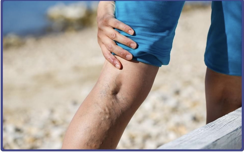 Varikozun müalicəsi nə üçün mütləqdir?