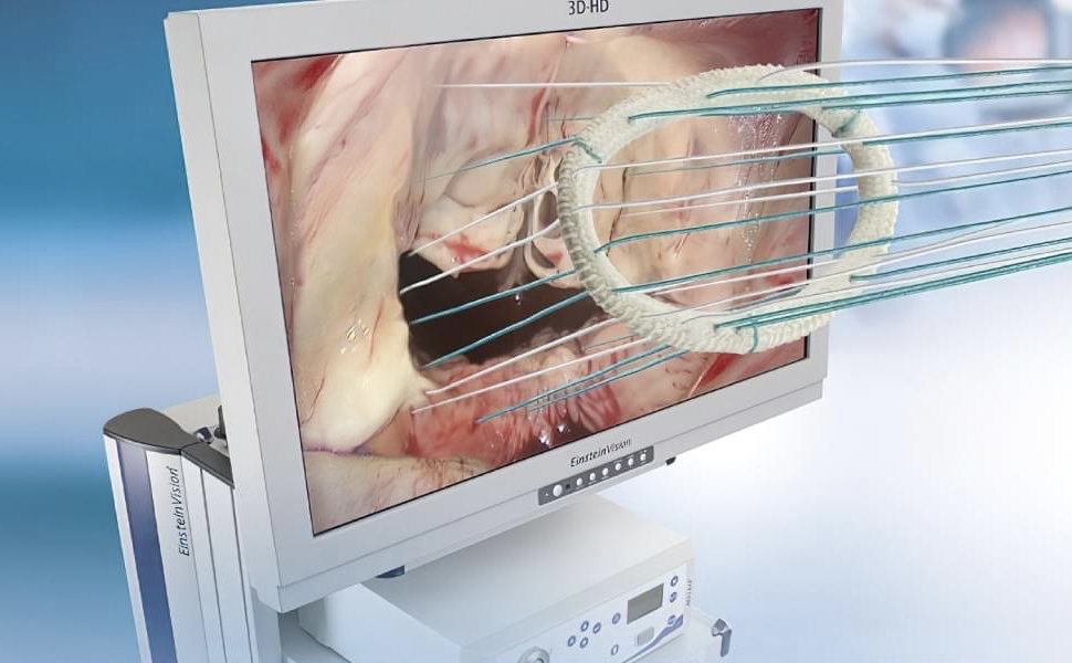 3D endoskop dəstəkli mitral qapaq təmiri əməliyyatı nədir? - Uzman həkim AÇIQLADI