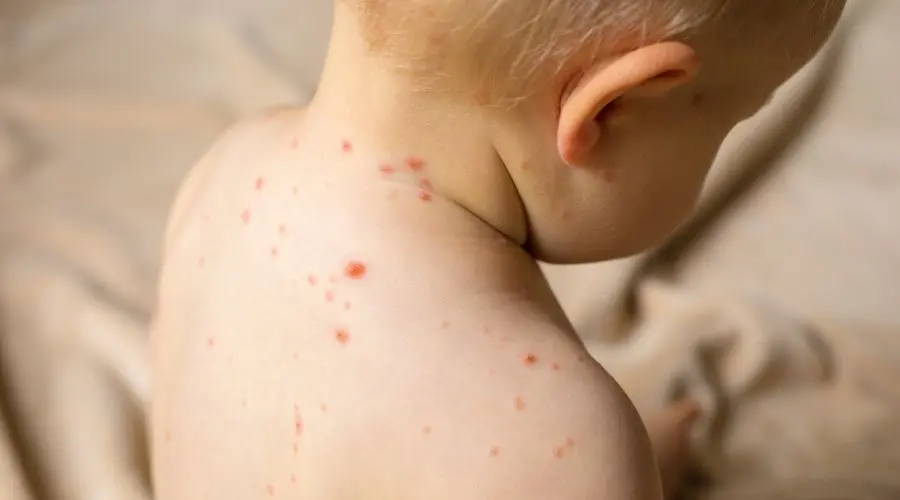 ABŞ-da son iki ayda 82 uşaq qızılcaya yoluxub