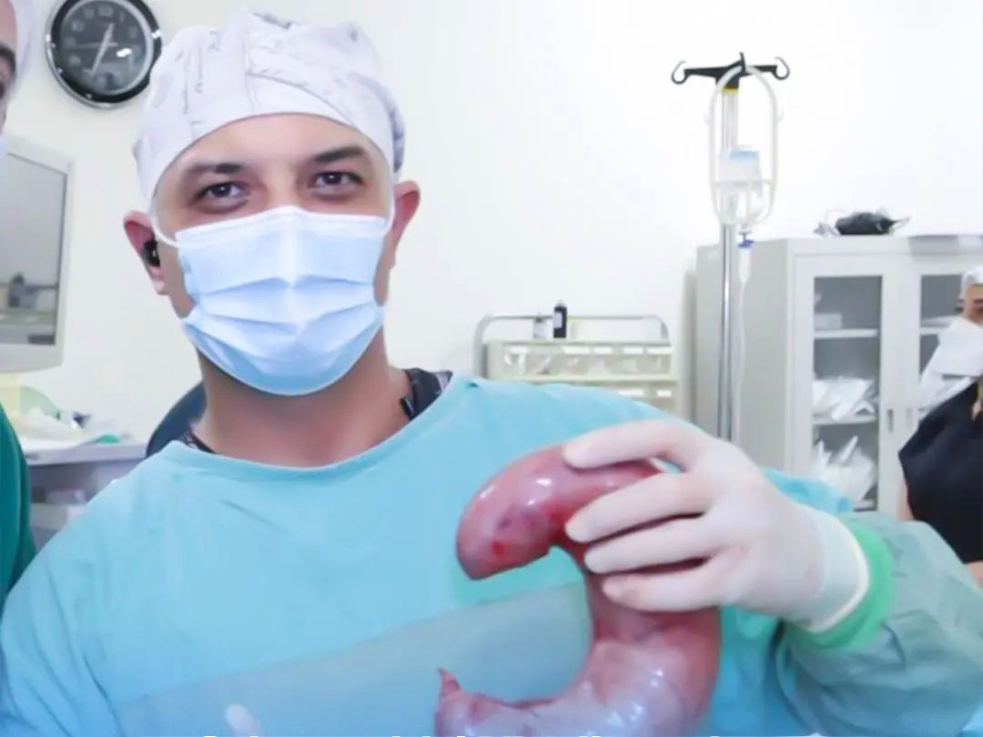 Mədə kiçiltmə əməliyyatından sonra düzgün qidalanma necə olmalıdır? - Ümumi cərrah AÇIQLADI