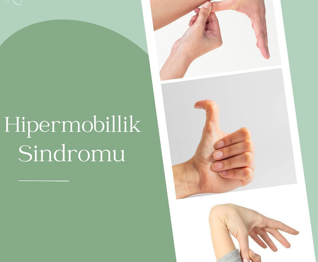 Hipermobillik sindromu. Simptomları nədir?