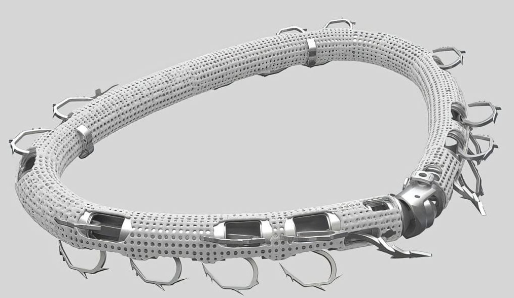 Mitral qapaq təmirinin üstünlükləri nədir? - Uzman həkim AÇIQLADI