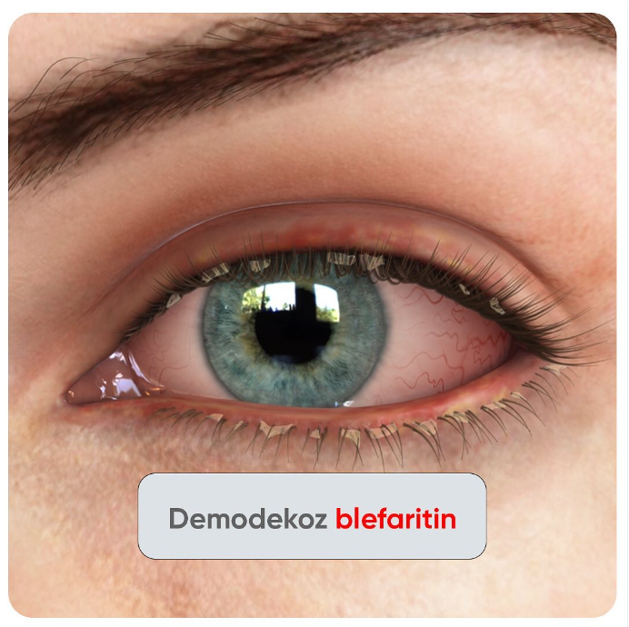 Demodekoz blefarit nədir?