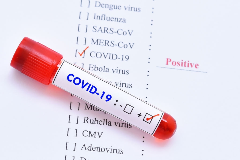Daha 56 nəfər koronavirusa yoluxub