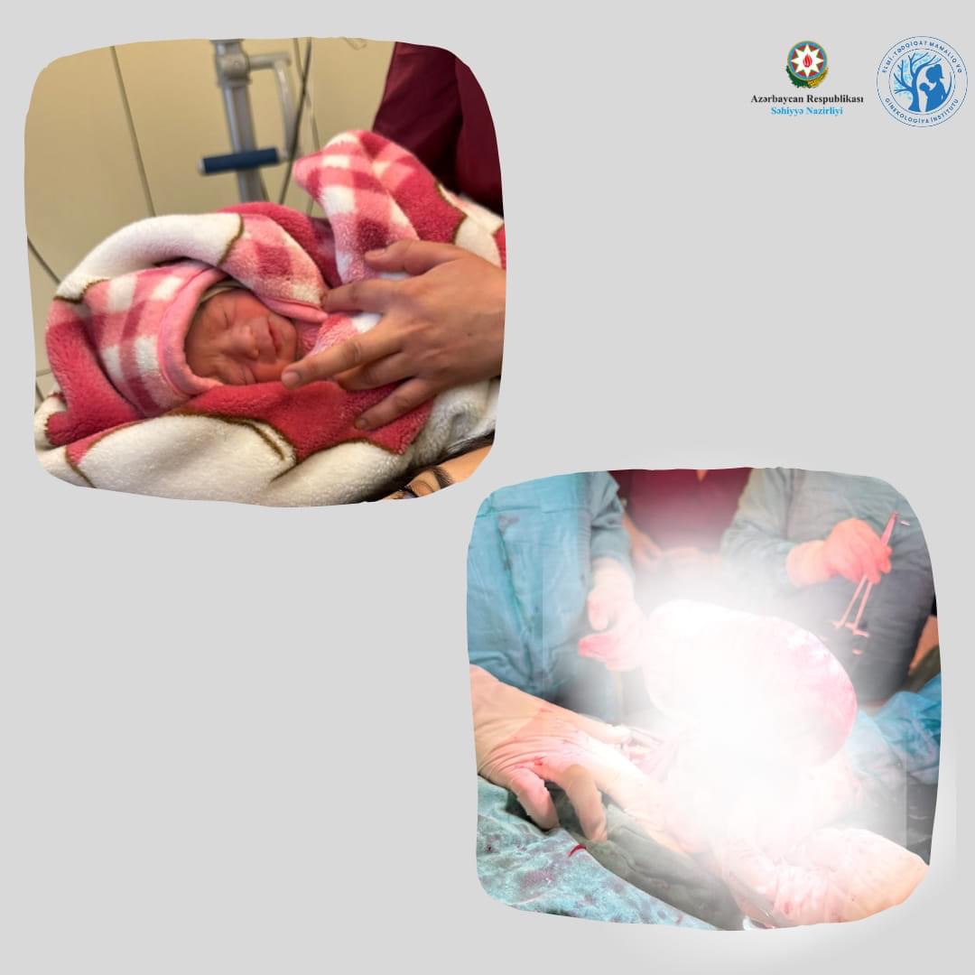 Daha bir riskli hamiləlik uğurla tamamlanıb  