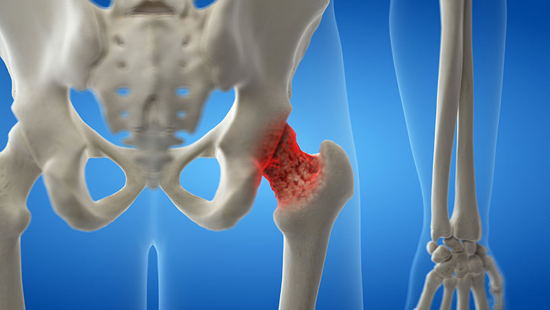 Osteoporozun simptomları – Boy azalır, qamət dəyişir