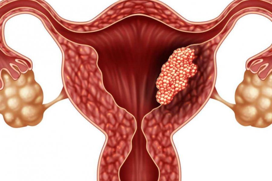 Ginekoloq: Vaginizm və endometrioz cinsi əlaqəni ağrılı edir