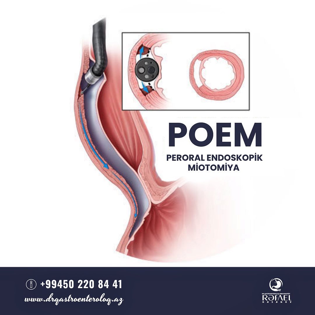 POEM necə tətbiq olunur?