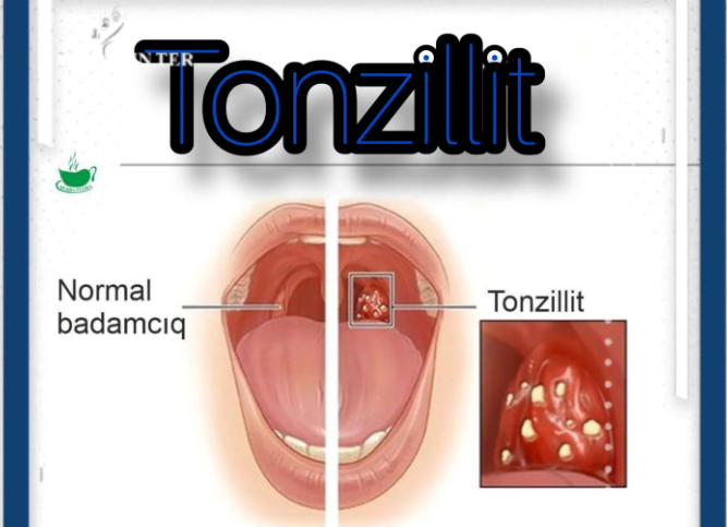 Otorinolorinqoloq: Tonzillitin simptomları keçməzsə…