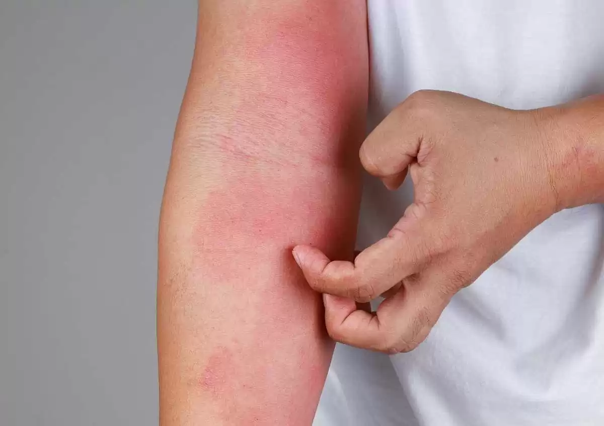 Allergik xəstəliklərin əlamətləri - Allerqoloq açıqladı