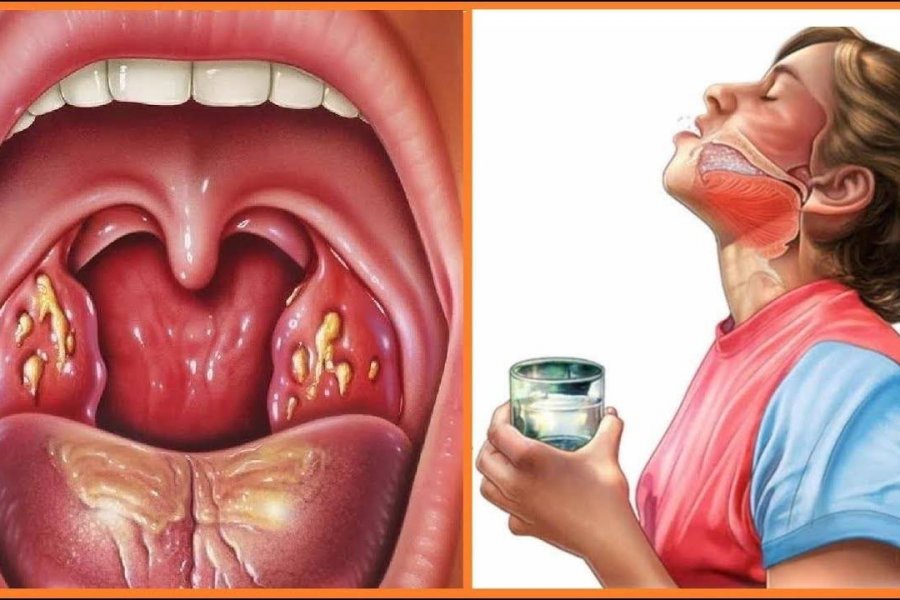 Həkim əlilliyə səbəb ola biləcək boğaz ağrılarından danışıb